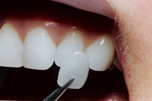 Lamina Diş Kaplama | Dent Elitium